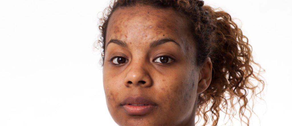 Say Goodbye to Acne Scars on Skin-of-Color with These 16 Effective Treatments