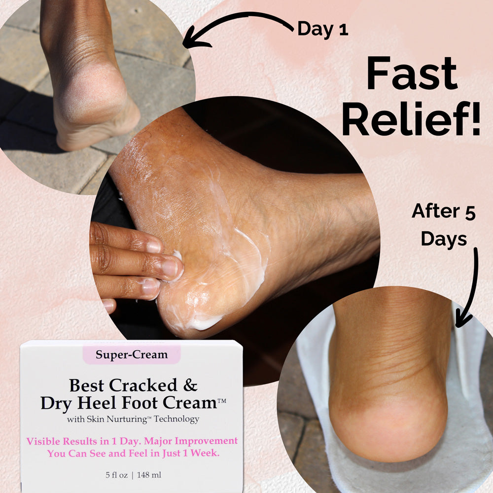 Heels Skin Under Foot Cracking Best Cracked Dry Heel Foot Cream